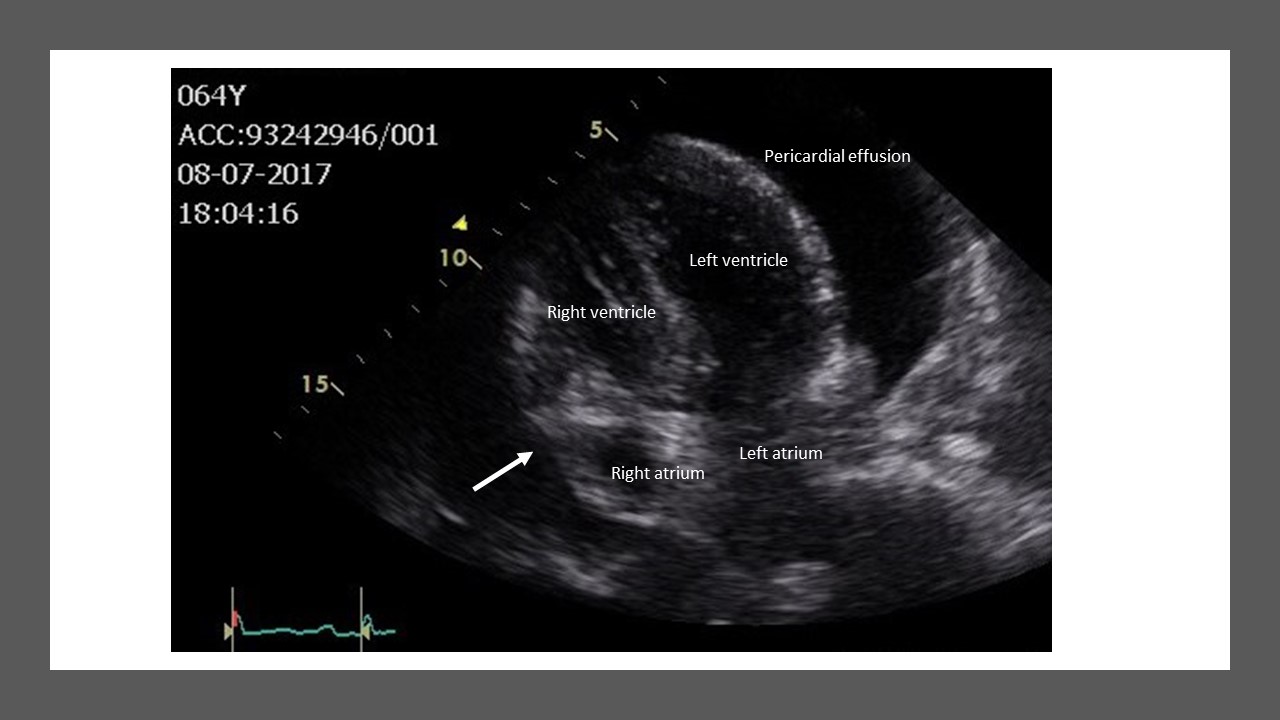 Cardiac tamponade a clinical challenge